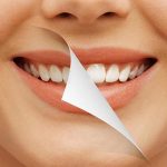 Fix Teeth Imperfections