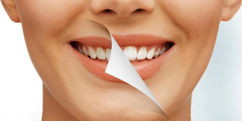 Fix Teeth Imperfections